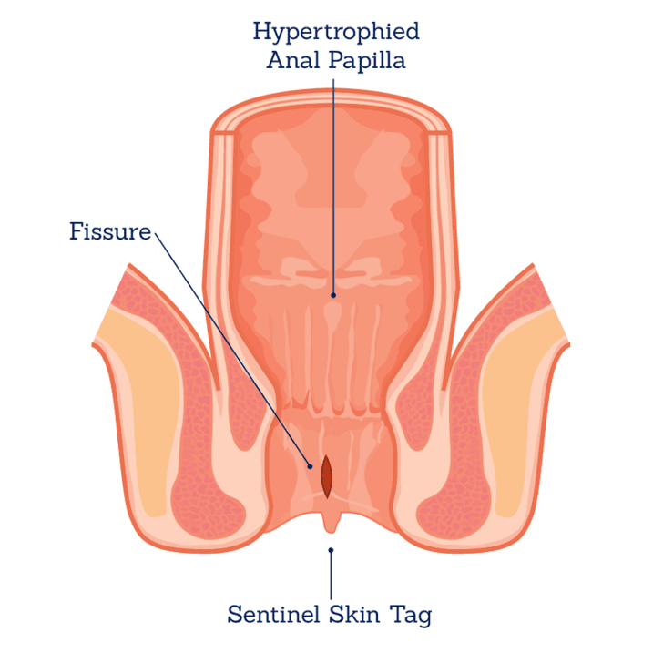 Fissure
